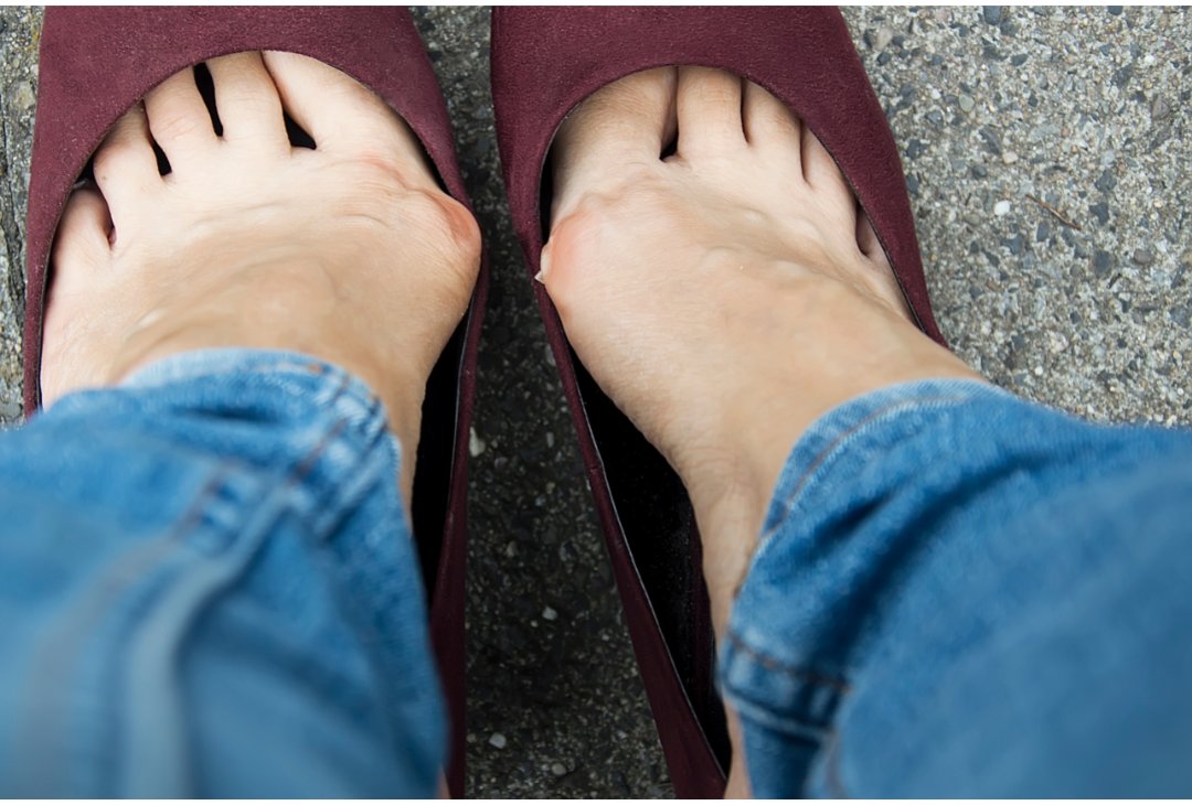Are Your Shoes Causing Foot Deformities? - Organic Mechanics Greenville SC