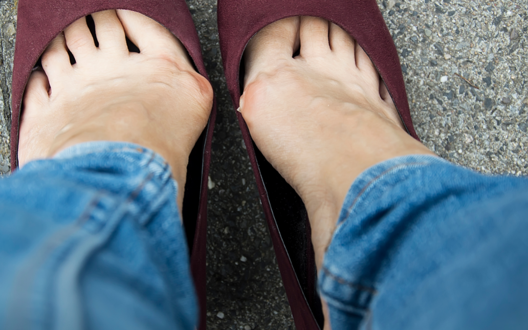Are Your Shoes Causing Foot Deformities?